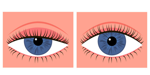 Comparison eye with down lid ptosis and healthy eye. Blepharoplasty, eyelid surgery. Correction aesthetic view of eye. Vector illustration