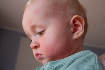 Nettle rash allergy on face in a toddler face.