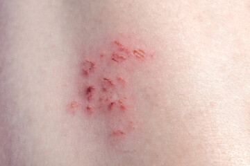 Abrasion on the skin, scratched injured damaged skin with a sore close up