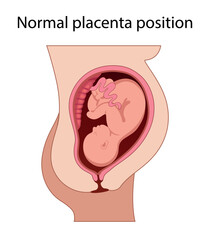 Fetus in Uterus During Pregnancy. Normal Placental Locations.  Pathology. 
Detailed Medical vector illustration.
 - obrazy, fototapety, plakaty