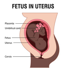 Fetus in Uterus During Pregnancy. Placental Locations Woman with dark skin.  Pathology. 
Detailed Medical vector illustration.
