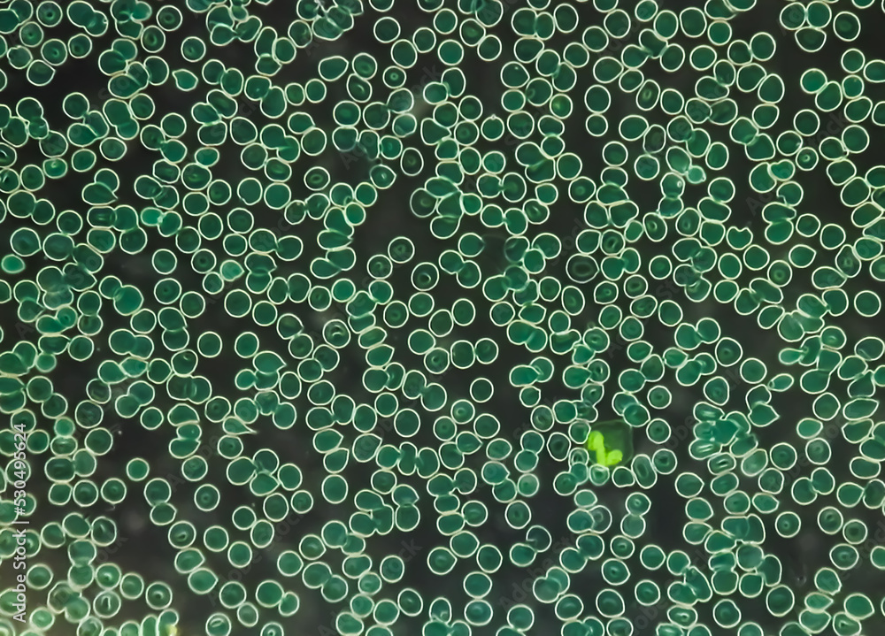 Poster microscopic view of hematological stained slide. thrombocytopenia. extremely low level of platelet c