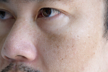 Close up Asian man face with freckles dark spots from uv light , skin care and health problem...