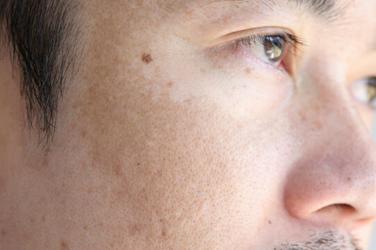 Close up Asian man face with freckles dark spots from uv light , skin care and health problem concept