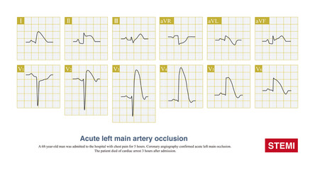 Fototapeta na wymiar Acute left main artery occlusion can cause both ST segment elevation and non ST segment elevation myocardial infarction, regardless of which type, the risk of death is high.