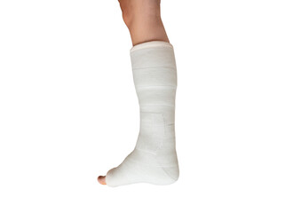 Woman with her broken leg. leg in a cast