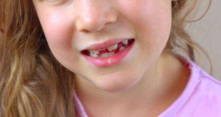 A close-up of the smile of a little girl without milk teeth, with growing permanent teeth.