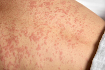 Close-up of a red rash on the human body. Human skin is covered with painful red spots - obrazy, fototapety, plakaty