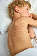 Sick little boy lies on his side on a hospital bed with a red rash all over his body. Child with a severe allergic reaction in the form of a rash in a hospital under the supervision of doctors - obrazy, fototapety, plakaty