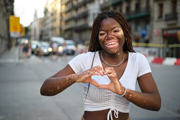 Young woman with vitiligo smiling while making heart shape with hands outdoors on the street.