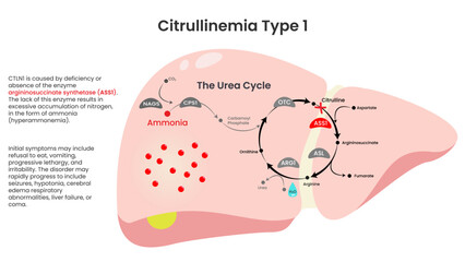 Citrullinemia Type 1 ASS1 Deficiency informational vector