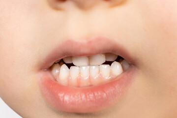 Milk teeth of a five-year-old child - bite, plaque on the teeth, hygiene and care.