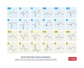 When acute left main artery occlusion occurs, QRS wave of ECG can be normal, or wide QRS wave can occur with intraventricular block, and the prognosis of the latter is worse.