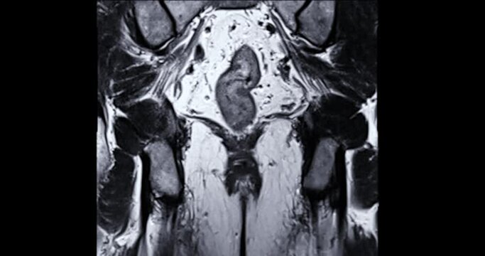 MRI prostate gland for diagnosis prostate cancer cell in aged men.