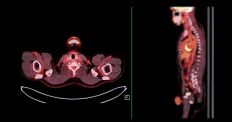 PET CT Scan fusion image of Whole human body  for detect cancer recurrence after surgery .