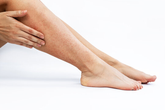 Irritation and redness on sensitive skin after epilation. Cropped shot of a young woman touching her legs with her hand after depilation isolated on a white background. Hair removal with wax, epilator