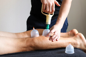 Cupping therapy. Cup vacuum massage. Cups for massage on the man's leg. © Yana Perelotova