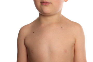 Naklejka premium Closeup view of boy's body with birthmarks on white background