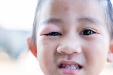 Stye Eye diseases. Closed Asian kid little girl eye with sty, eyelid abscess ophthalmic hordeolum - obrazy, fototapety, plakaty