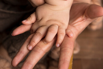 Polydactyly baby hand genetic condition