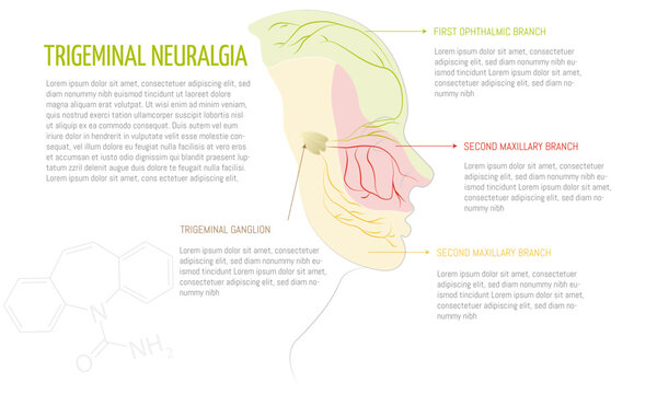 Infographic of the trigeminal neuralgia disease, areas affected by each branch of the trigeminal nerve. White background and space for text.