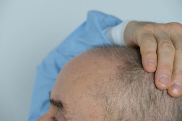 close-up old bald charismatic mature man showing his hair fall from head, patient with alopecia in...