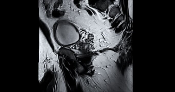 MRI prostate gland for diagnosis prostate cancer cell in aged men.