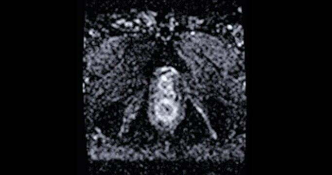MRI prostate gland for diagnosis prostate cancer cell in aged men.