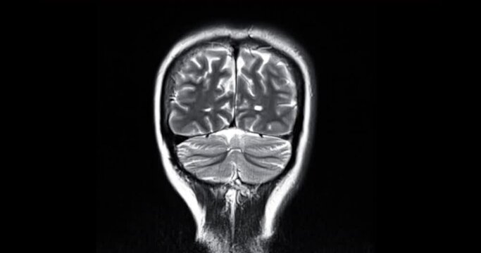 MRI Brain coronal T2W view for detect stroke disease and brain tumor.