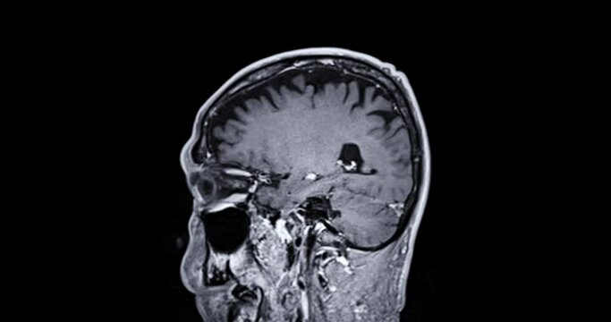 MRI of the brain with gadolinium contrast media for diagnosis brain tumor and stroke diseases . magnetic resonance imaging of the brain.