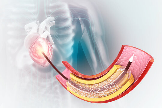 Stent and catheter for implantation into blood vessels. 3d illustration