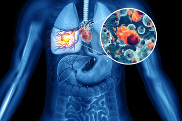 Medical Illustration showing lung cancer or bronchial carcinoma on medical background, 3d illustration - obrazy, fototapety, plakaty