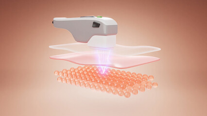 HIFU laser facial treatment with machine. 3D rendering - obrazy, fototapety, plakaty