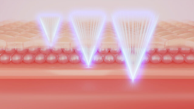 Facial Treatment With Three Shot Type Of HIFU Laser. 3D Rendering