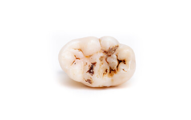 Close-up of a tooth with caries isolated on a white background. Removed wisdom teeth. Sick human teeth.