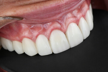 perfect white teeth woman perfect smile