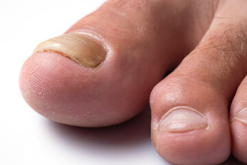 Toe nail with psoriasis and healthy toe nails, Psoriatic nail, close-up.