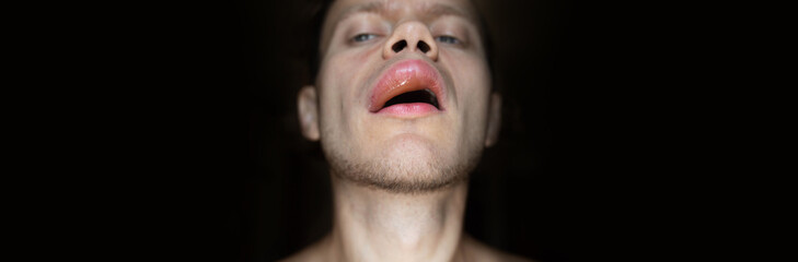 plump lips, allergic reaction of angioedema in a man on the lip. The concept of lip augmentation, cheiloplasty - lipofilling and botox injections