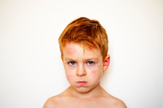portrait of a boy with allergies. red sick child's eyes. blotchy face