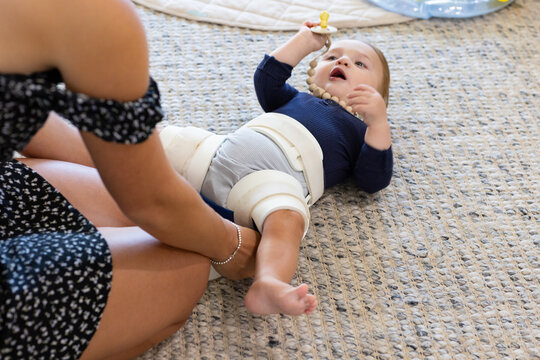 mother applying hip abduction brace to baby with hip dysplasia