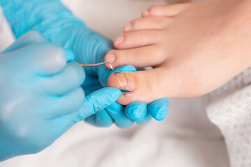 A podologist in blue gloves cleans a toenail with titanium thread. Close-up. The concept of podology and chiropody - obrazy, fototapety, plakaty