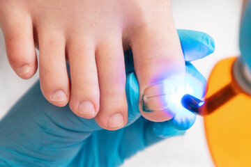 Professional pedicure. An orthopedist installs a titanium thread on the big toe. Correction of ingrown toenail. Close up, top view. The concept of podology and chiropody