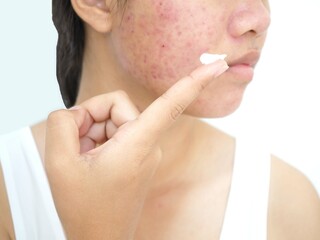Acne and face skin problem, Young woman applying acne cream medication, Topical pimple gel drug treatment. Closeup photo, blurred.