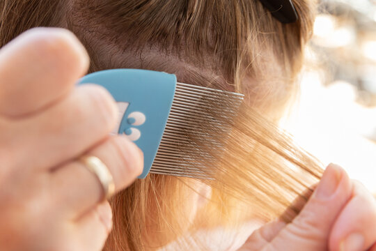 Head Lice Head Treatment,stock Photography