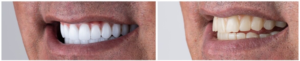 dental job photography, crowns veneers implants