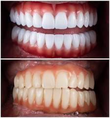 dental job photography, crowns veneers implants