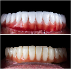 dental job photography, crowns veneers implants