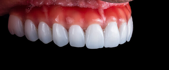 dental job photography, crowns veneers implants