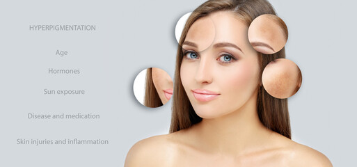 Dark spots, freckles,hyperpigmentation(melasma or chloasma),concept - skin lightening, skin...