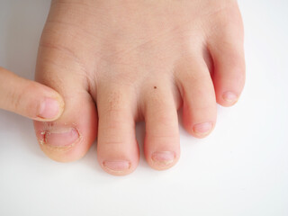 Kid boy feet with eczema dermatitis and fungal infections. Medical concept. Closeup photo, blurred.